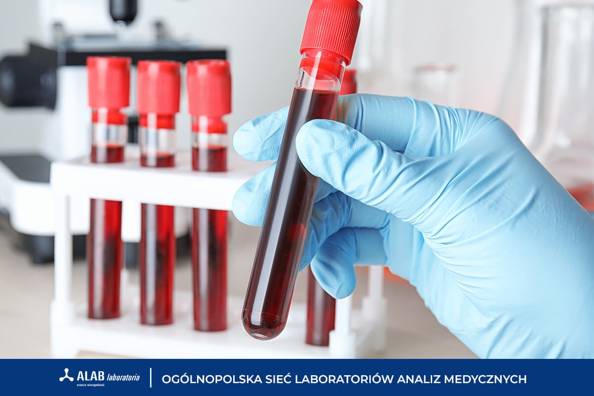 Morfologia krwi – badanie, które warto wykonywać regularnie